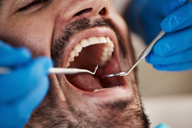 Best Emergency Tooth Extraction in Chesterfield, IN
