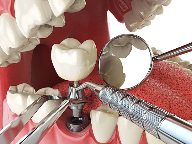 Best Emergency Dental Surgery in Chesterfield, IN