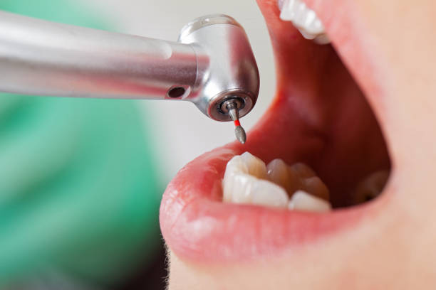 Best Walk-In Emergency Dentist in Chesterfield, IN